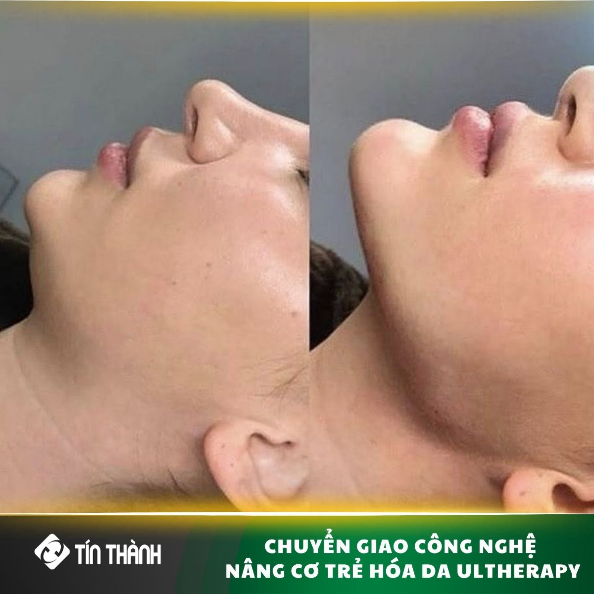 Bàn giao máy nâng cơ HIFU cho spa